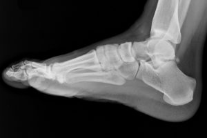 Outdoor Hazards: Sprained Ankle